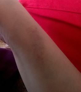 Blood sample bruises 3rd July