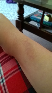 Blood sample bruise 4th July. 