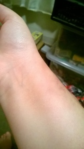 Blood sample bruising (wrapping around my wrist!) 7th July.