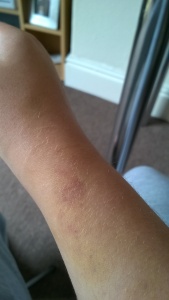Blood sample bruise. 14th July.