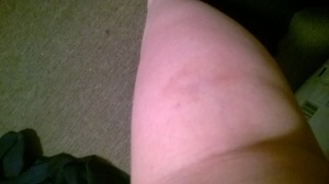 Calf bruise  16th July