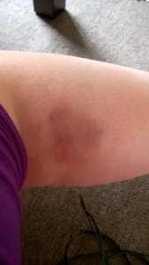 Calf bruise 20th July.  What a beauty, right?
