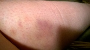 Calf bruise 24th July